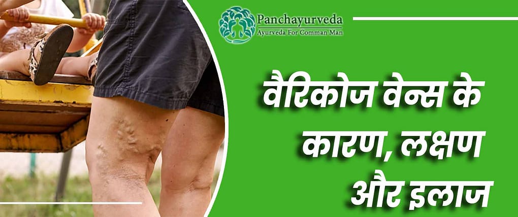 वैरिकोज वेन्स के कारण, लक्षण और इलाज