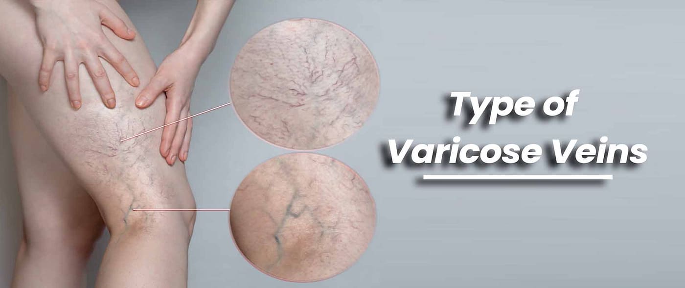 Type of Varicose Veins
