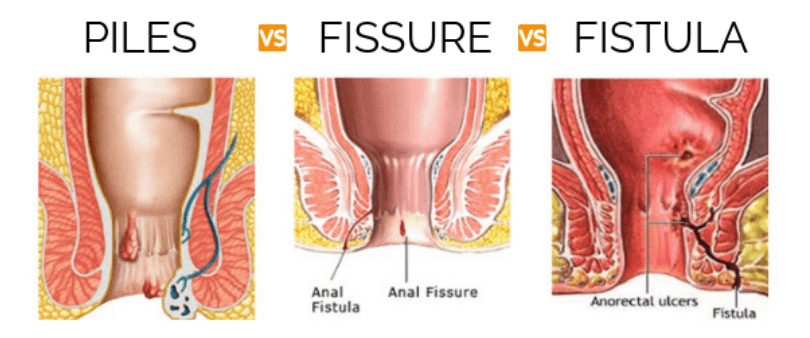 Diffrent between Piles, Fissure, Fistula in hindi