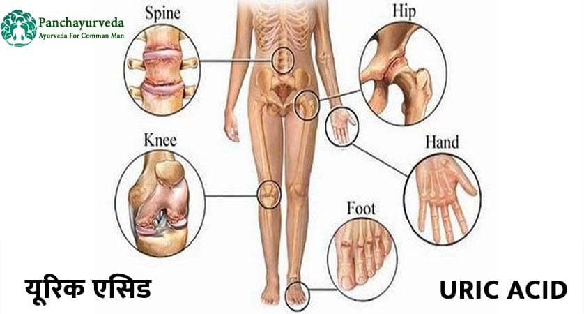 Uric Acid treatment in Ayurveda in Hindi